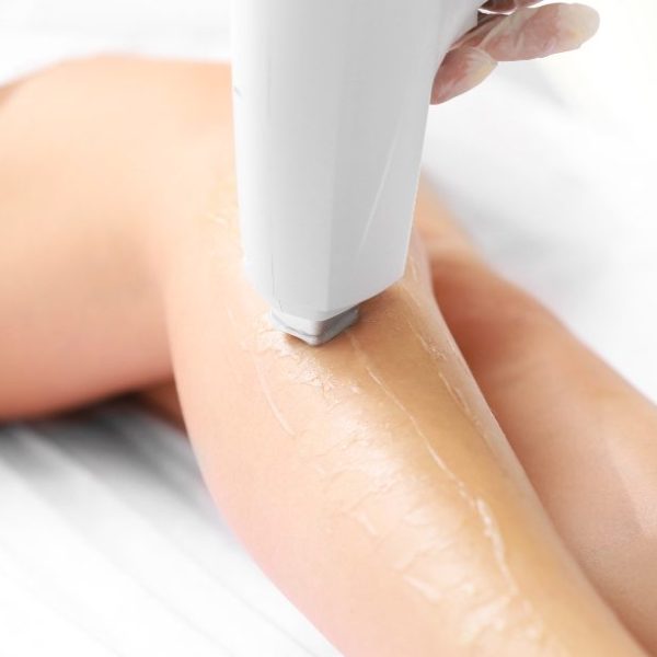 Epilação a laser SHR